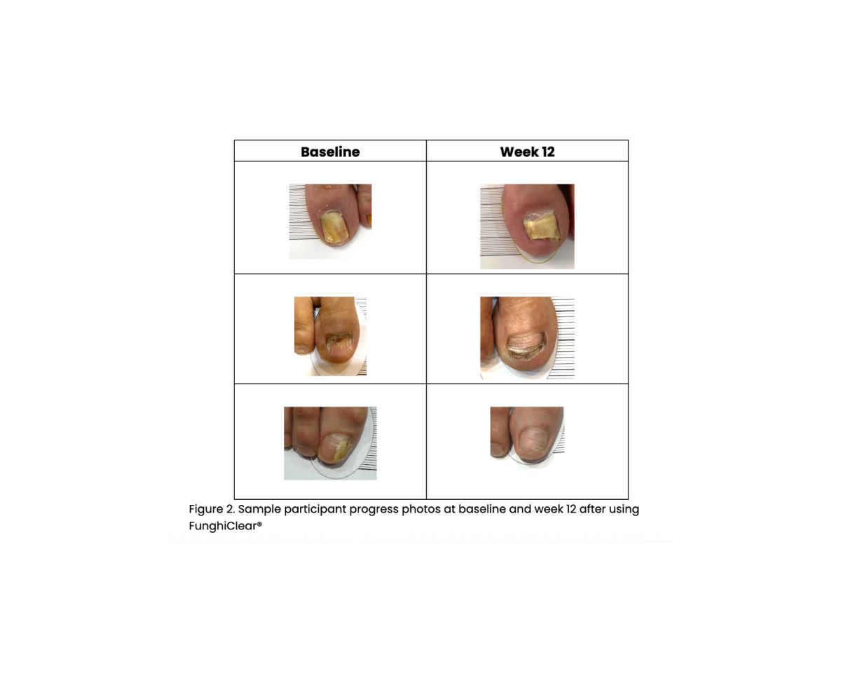 Figure 2. Sample participant progress photos at baseline and week 12 after using FunghiClear®